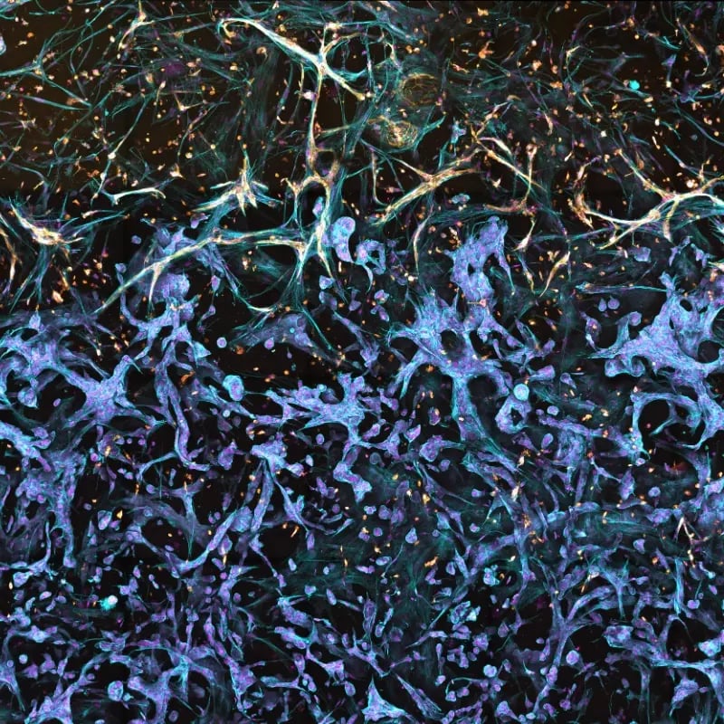 Tumor Stroma Interface