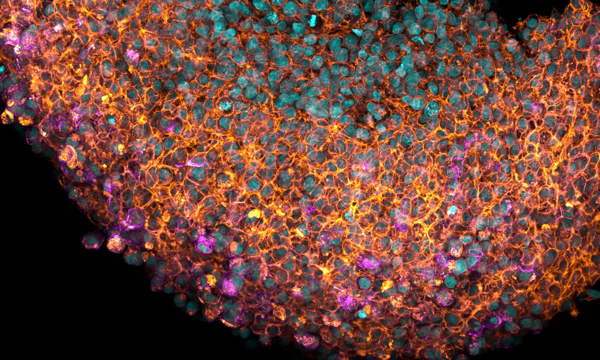Clamping down on the causes of pre-eclampsia