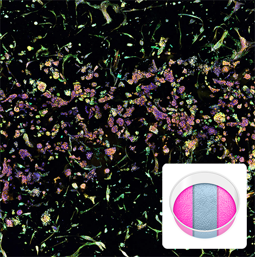 Fluorescent microscopy image of tumor-fibroblast cell interactions in a RASTRUM Triple Matrix Model. Cells stained for nuclei (blue), endoplasmic reticulum (green), and actin (yellow) show interactions across three distinct matrix compartments. Inset displays a schematic of the Triple Matrix Model.
